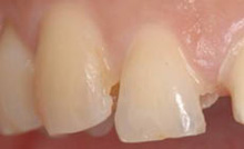 虫歯を除去1
