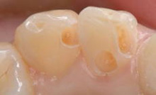 虫歯を除去2