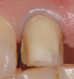 歯茎を傷つけないよう歯と歯茎の間に糸を入れ削った後に型取り