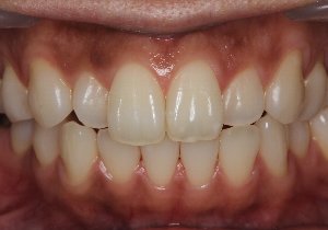 ホワイトニングと歯茎の黒ずみ除去 術前