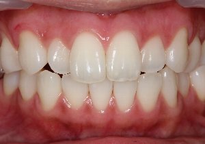 ホワイトニングと歯茎の黒ずみ除去 術後