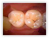 初期虫歯before