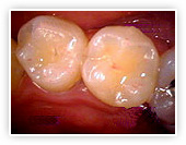 初期虫歯after